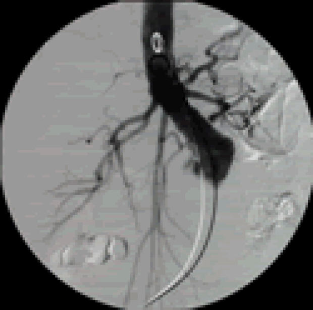 Angio of prox aortogram