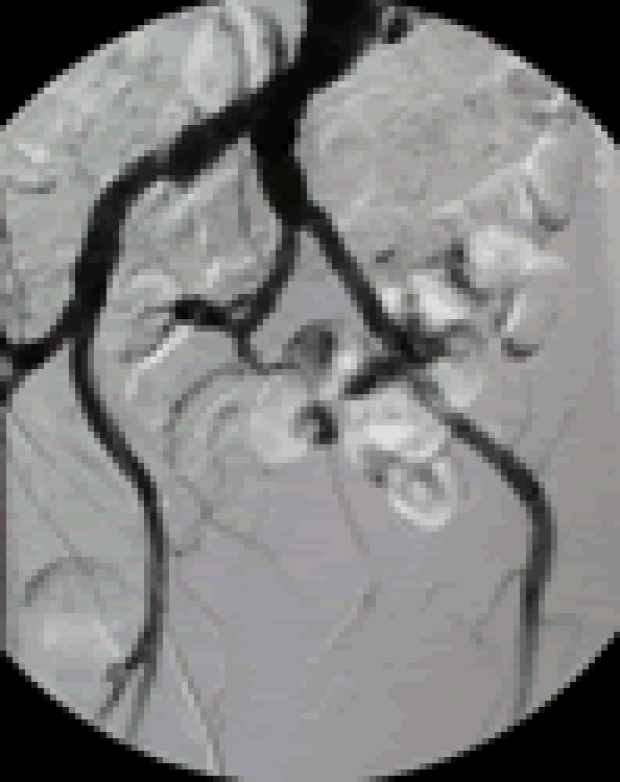 Angio of distal aortogram