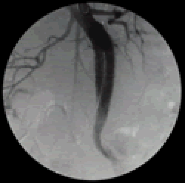 OEC angio of prox aorta